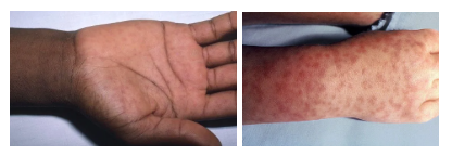 Rocky Mountain Spotted Fever